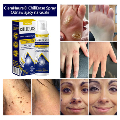 🥇CleraNaure® ChillErase spray do usuwania nierówności
