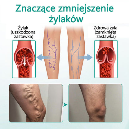 🥇CleraNaure® LegRenew Plaster na żylaki